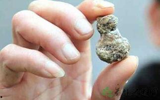 肾结石可以吃毛瓜